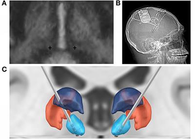 Case Report: Responsive Neurostimulation of the Centromedian Thalamic Nucleus for the Detection and Treatment of Seizures in Pediatric Primary Generalized Epilepsy